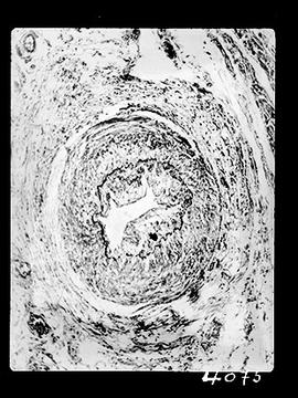 Fotomicrografia (miocardite) - Doença de Chagas (sequência 10 de 10)