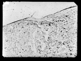 Fotomicrografia de corte histológico de lesão queloideforme