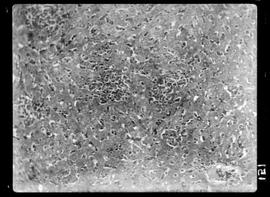 Fotomicrografia de Hanseníase experimental, fígado, trombos necrose infiltração com aumento de 70...