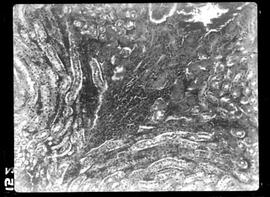 Fotomicrografia de Hanseníase experimental, rim (infiltração do tecido interstical) com aumento d...