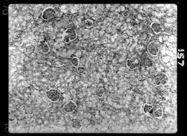 Fotomicrografia de Hanseníase experimental, fígado, trombos necrose infiltração com aumento de 70...