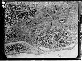 Fotomicrografia de ovos de esquistossoma no miocárdio com aumento de 50 vezes - Esquistossomose