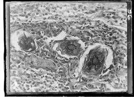 Fotomicrografia de ovos de esquistossoma no miocárdio com aumento de 500 vezes - Esquistossomose